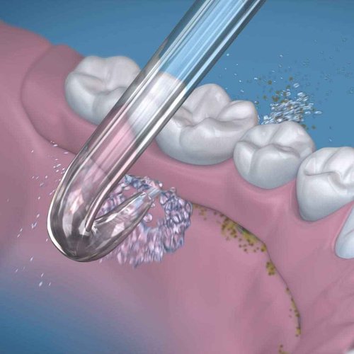 Waterpik Aquarius Water Flosser + 2 Replacement Implant Denture Tips for Water Flossers