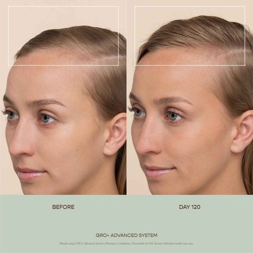 VEGAMOUR GRO+ Advanced Hair Serum for Improving Hair Density, Reduces Shedding and Promotes a Healthy Scalp, 1 pack